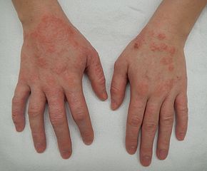 Dry Skin Hand Dermatitis